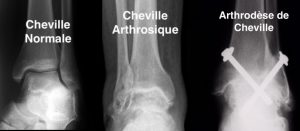 arthrose-cheville
