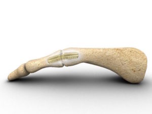 arthrodese-ipp