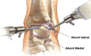 arthroscopie-anterieure-cheville