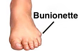 bunionette