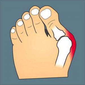 hallux-valgus-2