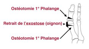 hallux-valgus-chirurgie