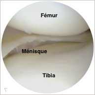 menisque-arthro