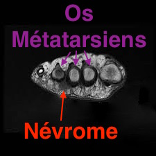 nevrome-morton-2